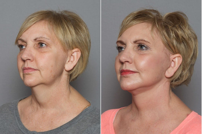 45-54 year old woman treated with Neck Lift - This patient came in wanting to rejuvenate her look before her daughter's wedding. After listening to Dr. Ho's recommendations, the patient elected to have a facelift, necklift and prejowl implant.