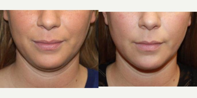 25-34 year old woman treated with Kybella - This 28 year old female met with Board Certified Plastic Surgeon, Dr. Brian S. Glatt, to learn about Kybella.&nbsp; She has only been treated once so far and is still under the care of Dr. Glatt for her second treatment. Updated pictures will be provided upon results from her next round of treatment, however her results are already quite promising!