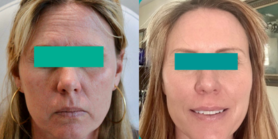 35-44 year old woman treated with Halo Laser - Upper face Daxxify and a Whole face Halo hybrid fractional laser.~ 7 days of downtime1 treatment