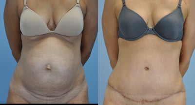 35 year old mother undergoes Abdominoplasty - 
	This 35 year old mother underwent an abdominoplasty. She was very happy with her outcome after surgery. Photos were taken at 2 months post op.
