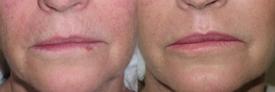 55-64 year old woman treated with CO2 Laser - Fractional carbon dioxide laser to permanently treat the upper lip lines. This patient will no longer require fillers