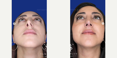 Woman treated with Revision Rhinoplasty - Just 6 weeks after Revision Rhinoplasty and this patient is feeling and breathing so much better!She had her first rhinoplasty by another surgeon and all though he made her nose smaller, without a straight foundation, this lead to severe deviation and nasal obstruction, valve collapse and a hanging columella.My Revision Rhinoplasty with my signature tip support technique was able to correct all of her issues - and now, she could not be happier with her nose and says this is the nose Ive always wanted.Elegant, natural and open airways. This is what its all about!