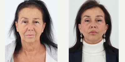 55-64 year old woman treated with Facelift, Neck Lift, Brow Lift, Eyelid Surgery, Facial Fat Transfer, CO2 Laser, Lip Fillers - 61 year old patient is 4 months post facelift, neck lift, fat transfer, upper bleph, brow lift, co2 laser