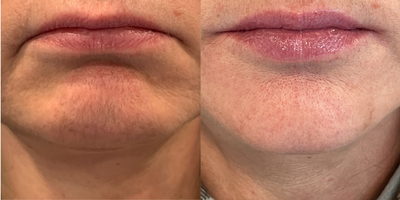 55-64 year old woman treated with Chin Filler - Chin filler injected at 8 West Clinic, Vancouver, BC