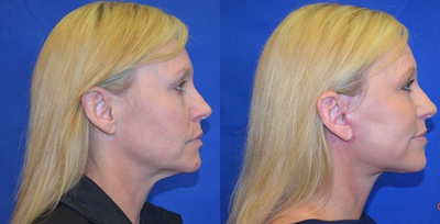 40-49 year old woman treated with CO2 Laser - 40-49 year old woman treated with CO2 Laser