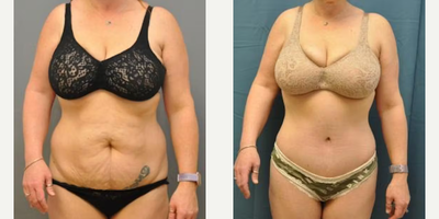 Woman treated with Tummy Tuck - Woman treated with Tummy Tuck