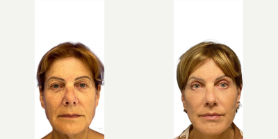 65 year old woman treated with Eyelid Surgery - 65 year old woman treated with Eyelid Surgery as well asBrow Lift, Deep Plane Facelift, Lip Lift, and Facial Fat Transfer. Pre-op, patient was unhappy with her jowls, eyes, and lack of jaw definition.