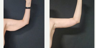 35-44 year old woman treated with Arm Lift - Arm Lift