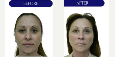 55-64 year old woman treated with Thread Lift, MINT threadlift - mint threadlift