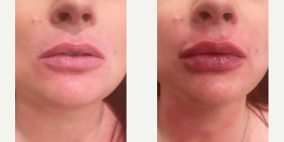 Woman treated with Juvederm - Woman treated with 1ml of Juvederm XC as lip fillers
