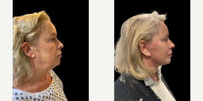 Woman treated with Neck Lift - Woman treated with Neck Lift