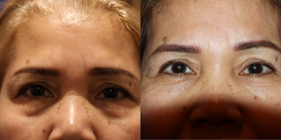 45-54 year old woman treated with Brow Lift - Brow lift and Renuvion