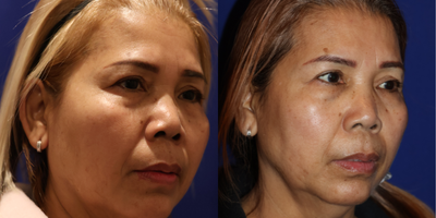 45-54 year old woman treated with Brow Lift - Brow lift and Renuvion