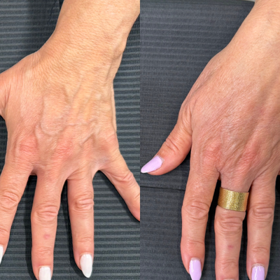 55-64 year old woman treated with RHA Collection Fillers, CO2 Laser - In this case, a multi-modality approach was utilized, combining dermal filler to restore soft tissue volume with laser resurfacing to address skin quality and laxity.This treatment resulted in subtle yet noticeable improvement in volume, texture, and overall hand aesthetics, with minimal downtime.