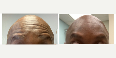 45-54 year old man treated with Botox - Botox to glabellar region and forehead.