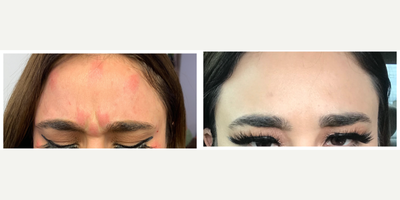 25-34 year old woman treated with Botox - Botox to glabellar region and forehead.