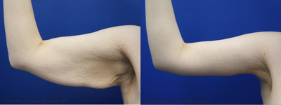 45-54 year old woman treated with Arm Lift - 45-54 year old woman treated with Arm Lift (Brachioplasty)
