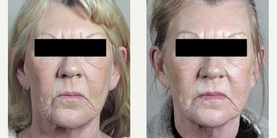 55-64 year old woman treated with Halo Laser - This patient was mostly concerned with wrinkles on her face. We used our Halo laser to treat her face and neck. The treatment stimulated collagen production, thus adding firmness to her skin, and also improved the appearance of her skins surface. Though the treatment was completely non-surgical and without downtime, the results are visible and she has a natural-looking glow.&nbsp;