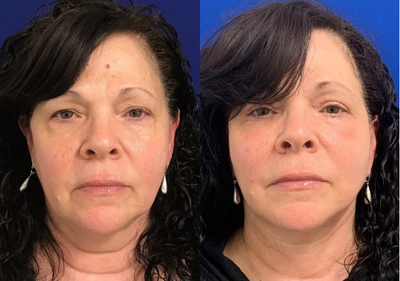 60 year old woman treated with Liposculpture - 60 year old woman treated with Liposculpture (Submental Liposuction)