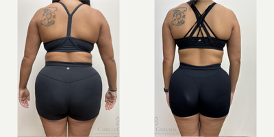 Semaglutide for weight loss with Evolve Transform treatments for proactive skin tightening - This patient is seen here before and 27 weeks later.During her once weekly rounds of my #CashedOut Semaglutide Weight Loss program, which also includes a separate B-12 injection for energy, she received EvolveX Transform body sculpting treatments. These hands-free, pain-free treatments combine the benefits of radiofrequency (RF) energy and electrical muscle stimulation (EMS) to sculpt, tone, and tighten various areas of the body. It targets stubborn fat, enhances muscle definition, and improves skin elasticity, offering a comprehensive solution for body transformation without surgery or downtime. We especially love this treatment for Semaglutide patients since they can be safely performed throughout ones weight loss journey as a proactive measure against loose skin caused by rapid volume loss, a common concern known in pop-culture as Ozempic Butt.She is seen here before and 27 weeks after starting our Semaglutide weight loss program. At 51, her weight loss from 176 to 155 significantly reduced her BMI from 33.3 (obesity range) to a much healthier BMI of 29.4.