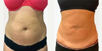 Woman treated with truFlex, Vaser Liposuction - Woman treated with truFlex, Vaser Liposuction