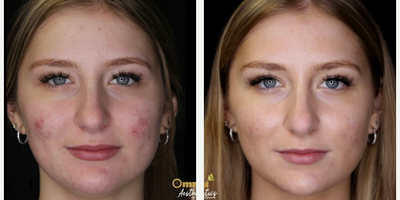 Woman treated with Sylfirm X - Woman treated with Sylfirm X