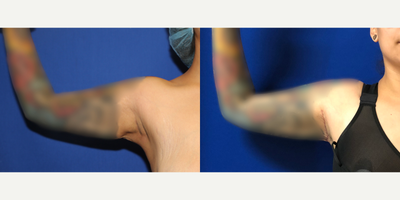 25-34 year old woman treated with Arm Lift - This patient in her late 20's was unhappy with the excess skin and fat of her arms by her armpits. The doctor performed a crescent arm lift to get rid of the excess skin and fat to achieve her desired results.