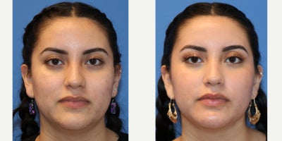 18-24 year old woman treated with Microneedling RF - 22 year old patient is seen before and after two treatments of Microneedling.