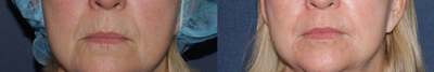 Active/Deep Fx - 
	Patient before and after Active/Deep FX treatment to remove pigmentation and improve skin texture.
