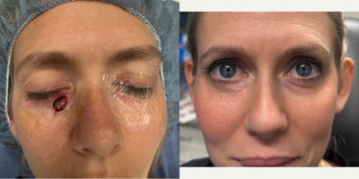 25-34 year old woman treated with Mohs Surgery - This lovely patient had an unfortunate skin cancer underneath her eye. Once this cancer was removed she was left with a sizable defect which we repaired with a combination of different reconstructive techniques to achieve the best possible results. So happy with how she has done and grateful her permission to share these photos!