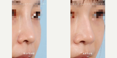 Woman treated with Rhinoplasty - Woman treated with Rhinoplasty