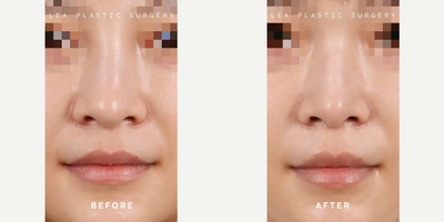 Woman treated with Rhinoplasty - Woman treated with Rhinoplasty