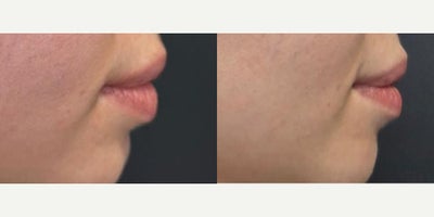 25-34 year old woman treated with Lip Reduction - Lower Lip Reduction surgery 7 weeks post operative