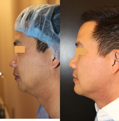 37 year old man treated with Chin Implant (Chin Augmentation) - 37 year old man treated with Chin Implant (aka chin augmentation) as well as Jawline Liposuction (300cc administered). After photo taken1 month post-op.