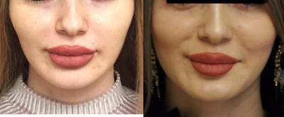 25-34 year old woman treated with Fat Transfer - 25-34 year old woman treated with Fat Transfer