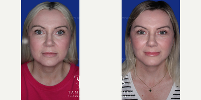 Woman treated with Revision Rhinoplasty - Woman treated with Revision Rhinoplasty