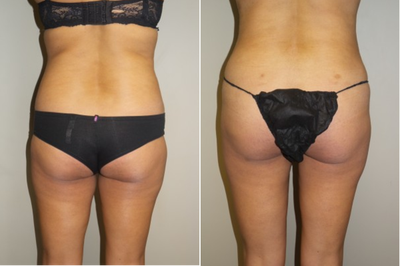 35-44 year old woman treated with Butt Lift - This 36 year old mother desired a fuller buttock and underwent a Brazilian Butt lift with fat grafting.