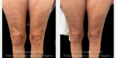 55-64 year old woman treated with Skin Rejuvenation, Microneedling RF, Morpheus8, Microneedling, Skin Tightening - Morpheus8 Body before and after by VIPS Cosmetic Center in Port St. Lucie, FL. After only two Morpheus8 Body RF microneedling treatments to the knees, this patient shows visible improvement in crepey skin texture, skin laxity, and overall firmness around the knees. Results will continue to improve for approximately 3 months following treatment.