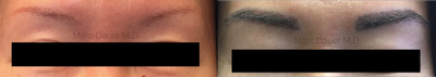 25-34 year old woman treated with Eyebrow Transplant - Eyebrow Restoration on female patient performed by Dr. Dauer