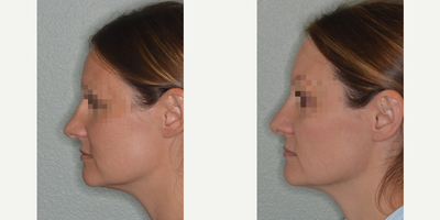 25-34 year old woman treated with Rhinoplasty - Patient with a severely crooked nose. Primary rhinoplasty techniques included an open rhinoplasty approach, right-sided osteotomy, bilateral spreader grafts, clocking suture, footplate suture, temporalis fascia onlay grafts, caudal septal extension graft, and tip onlay graft.
