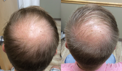 35-44 year old man treated with Hair Loss Treatment - One Dermapen treatment with PRP for hair restoration.