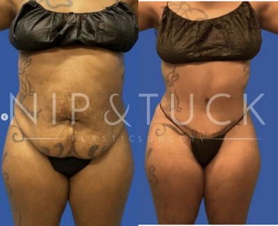 35-44 year old woman treated with Liposuction - 4 months s/p Abdominoplasty with lipo 360.