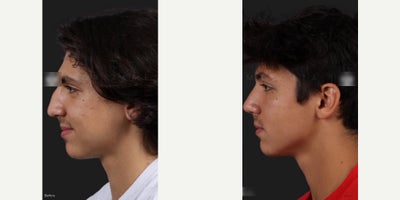 Man treated with Septoplasty - Man treated with Septoplasty