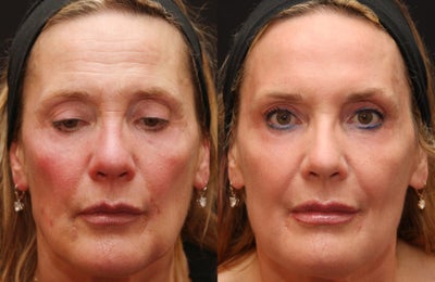 Fraxel Repair for Sun Damage and Wrinkles - Patient was treated with Fraxel Repair to improve skin tone and texture.