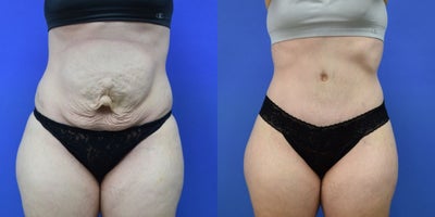 25-34 year old woman treated with Tummy Tuck, Drainless Tummy Tuck, Diastasis Recti Repair - This 33-year-old patient came to us after carrying twins and delivering via C-section, with concerns about severe diastasis recti and excess abdominal skin. Despite her efforts, these changes could not be corrected with lifestyle alone. A drainless tummy tuck allowed us to repair the muscle separation, remove the loose skin, and recreate a smoother, flatter abdominal contour. Her results look natural and proportional, helping her feel more like herself again after pregnancy.