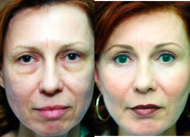 Eyelid Surgery - Eyelid Surgery