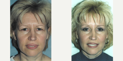 Brow Lift - Patient disliked the heaviness of her brow and eyelids.