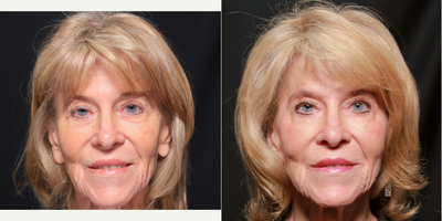 65-74 year old woman treated with Eyelid Surgery - Patient had Right Lid Ptosis Repair and Bilateral Upper Blepharoplasty with AGNES RF Brow Lift.Her eyes now look even, youthful and more awake.