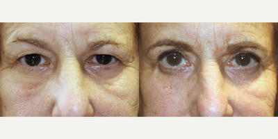 57 year old woman treated with Upper Blepharoplasty - 57 year old woman treated with Upper Blepharoplasty Surgery, giving the eyes a more youthful appearance.