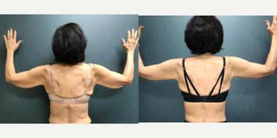 45-54 year old woman treated with Arm Lift - full arm lift after weight loss